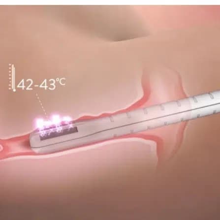 FormaV Vaginal Rejuvenation at Covalence Medical & Aesthetics (Graceful Touch) in Sarasota, FL