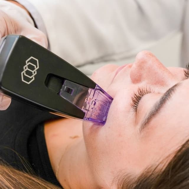 Morpheus8 Face Package at Covalence Medical & Aesthetics (Graceful Touch) in Sarasota, FL